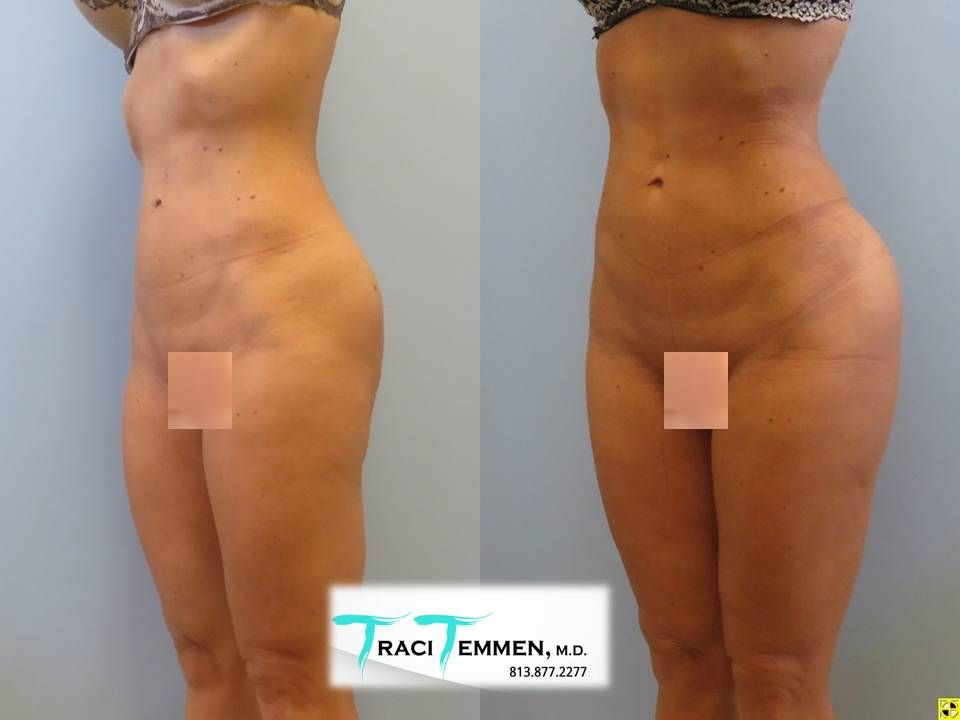 Gluteal Implants Butt Implants Before & After