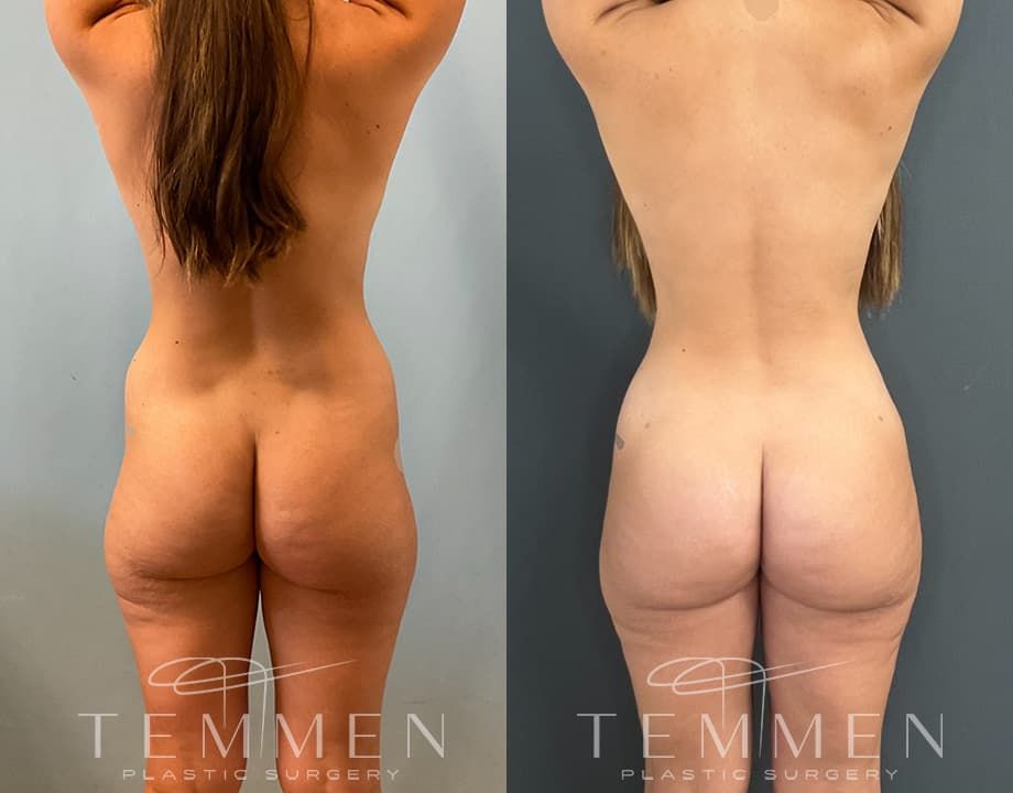 Skinny Brazilian Butt Lift Before & After