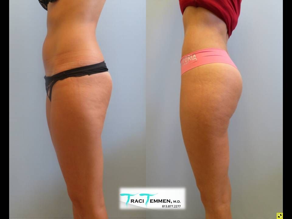 Skinny Brazilian Butt Lift Before & After