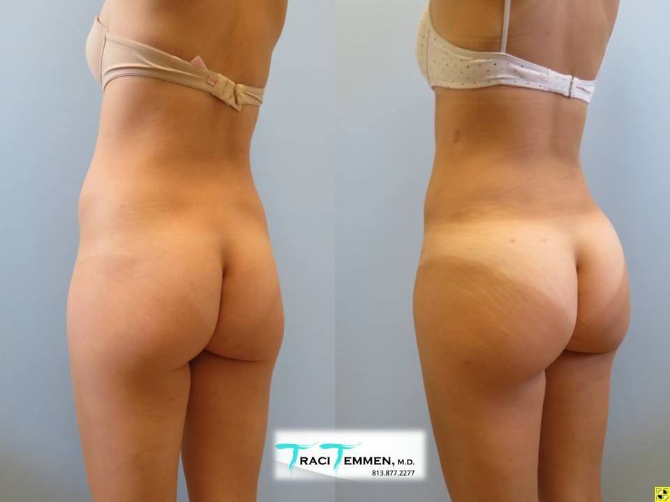 Skinny Brazilian Butt Lift Before & After