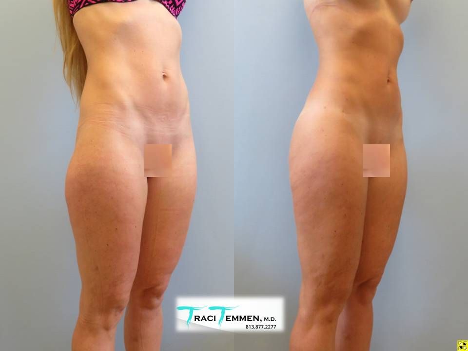 Skinny Brazilian Butt Lift Before & After
