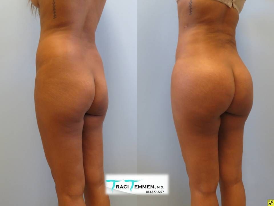 Skinny Brazilian Butt Lift Before & After