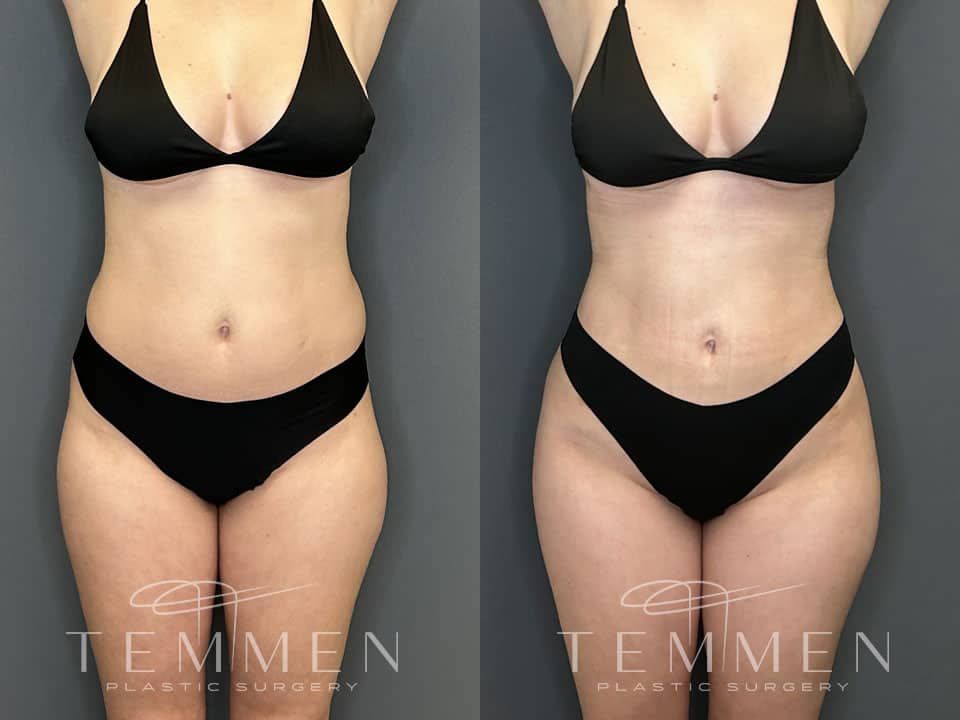 Skinny Brazilian Butt Lift Before & After