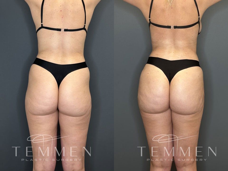 Skinny Brazilian Butt Lift Before & After