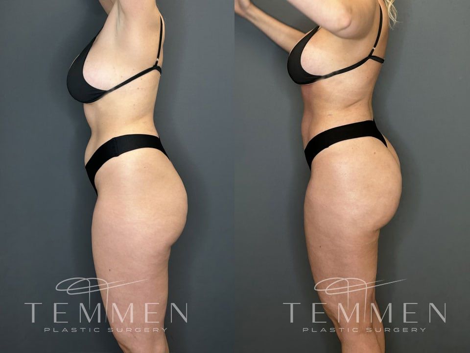 Skinny Brazilian Butt Lift Before & After