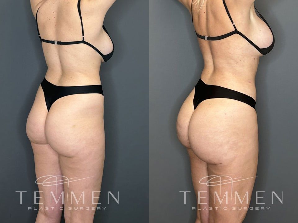 Skinny Brazilian Butt Lift Before & After