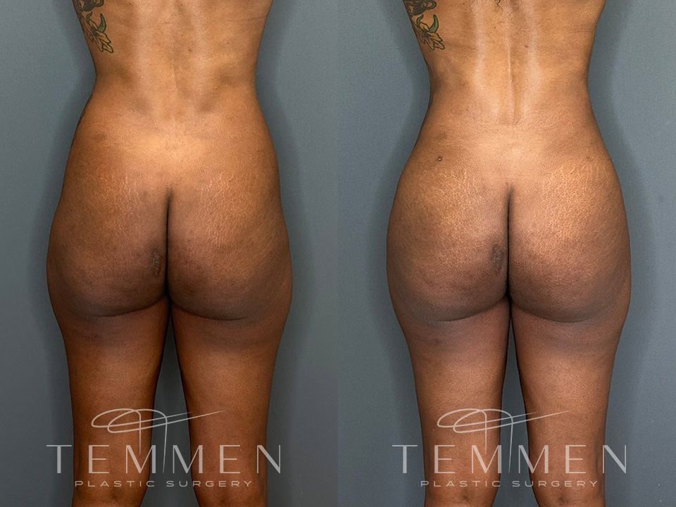 Skinny Brazilian Butt Lift Before & After