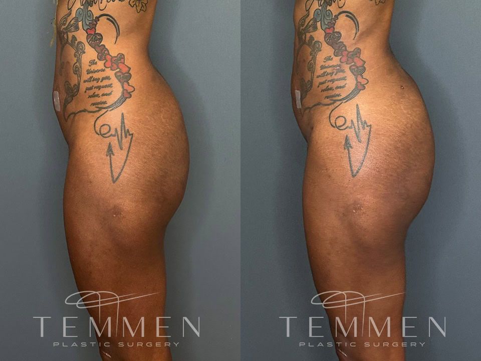 Skinny Brazilian Butt Lift Before & After