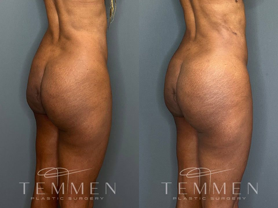 Skinny Brazilian Butt Lift Before & After