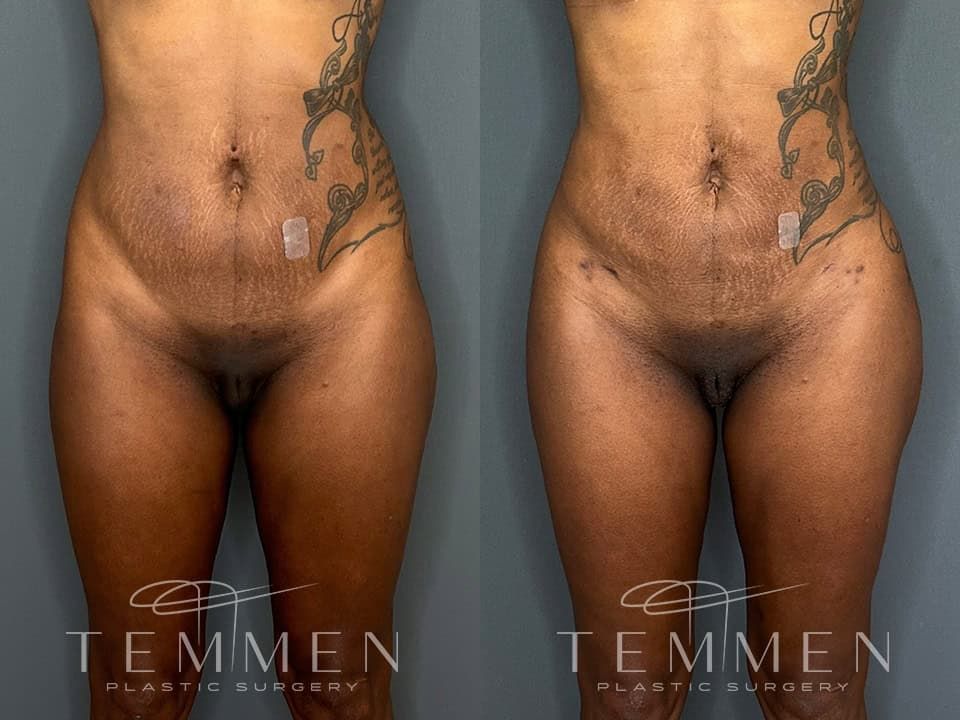 Skinny Brazilian Butt Lift Before & After
