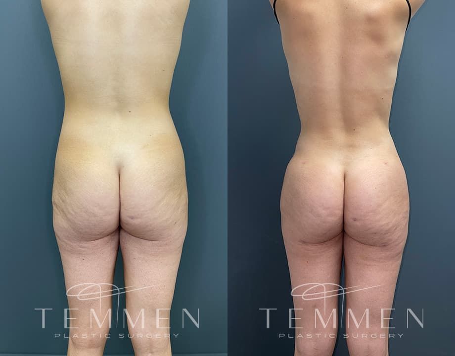 Skinny Brazilian Butt Lift Before & After