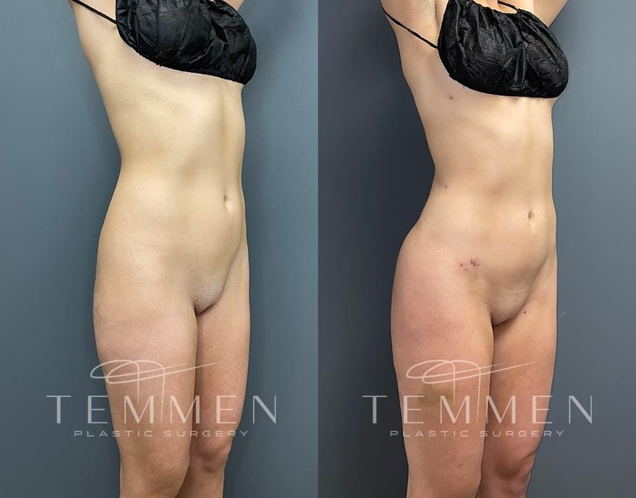 Skinny Brazilian Butt Lift Before & After