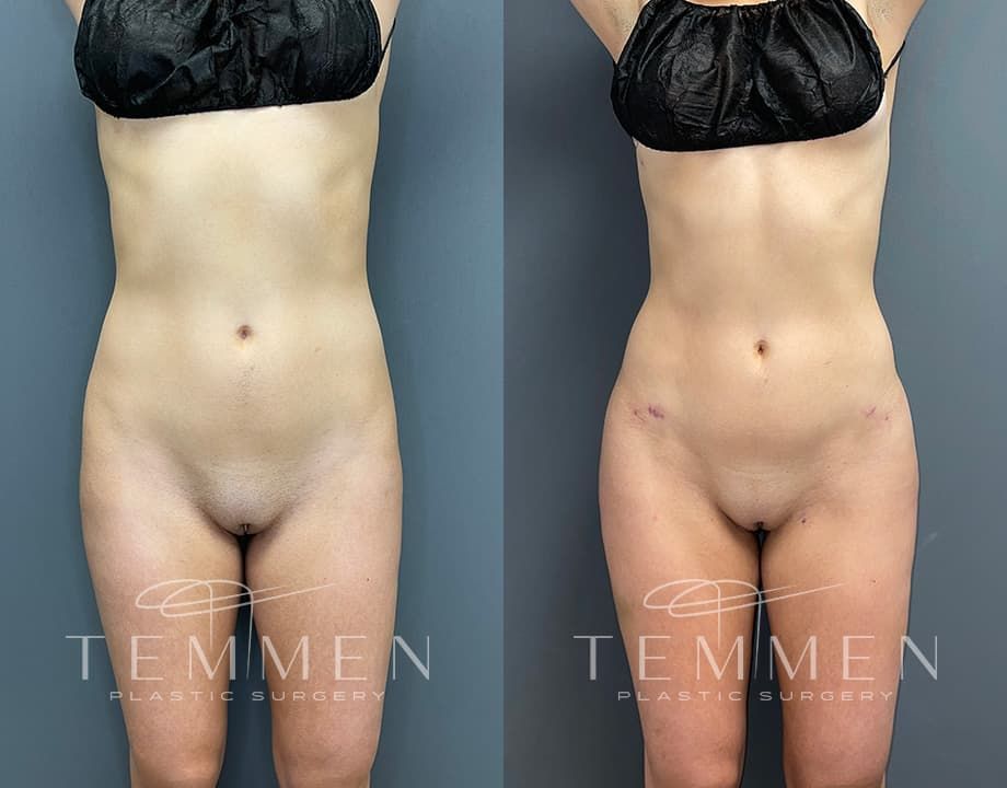 Skinny Brazilian Butt Lift Before & After