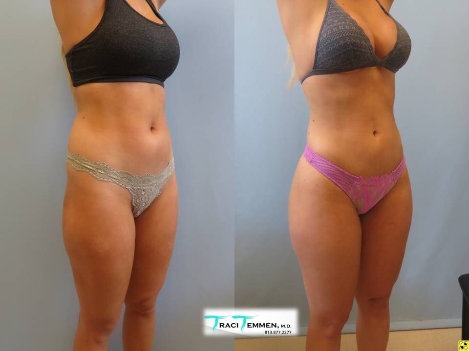 Skinny Brazilian Butt Lift Before & After