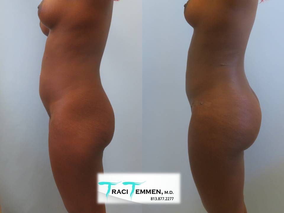 Skinny Brazilian Butt Lift Before & After