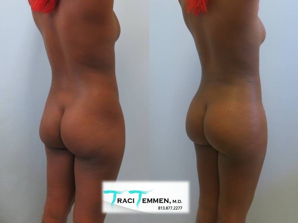 Skinny Brazilian Butt Lift Before & After
