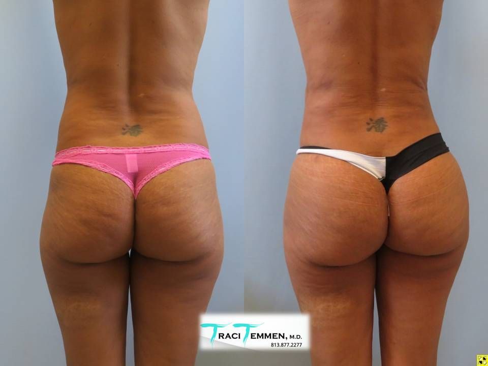 Skinny Brazilian Butt Lift Before & After