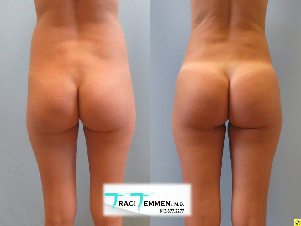 Skinny Brazilian Butt Lift Before & After