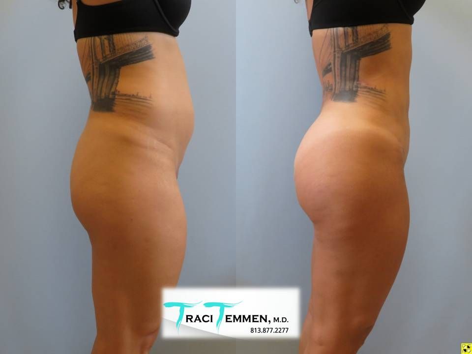 Skinny Brazilian Butt Lift Before & After