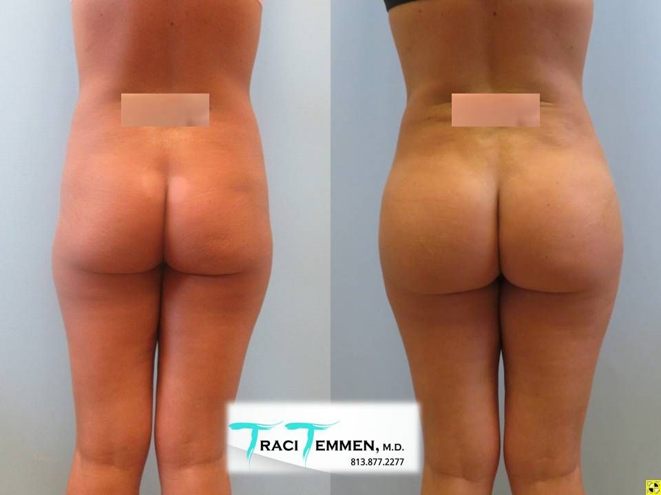 Skinny Brazilian Butt Lift Before & After