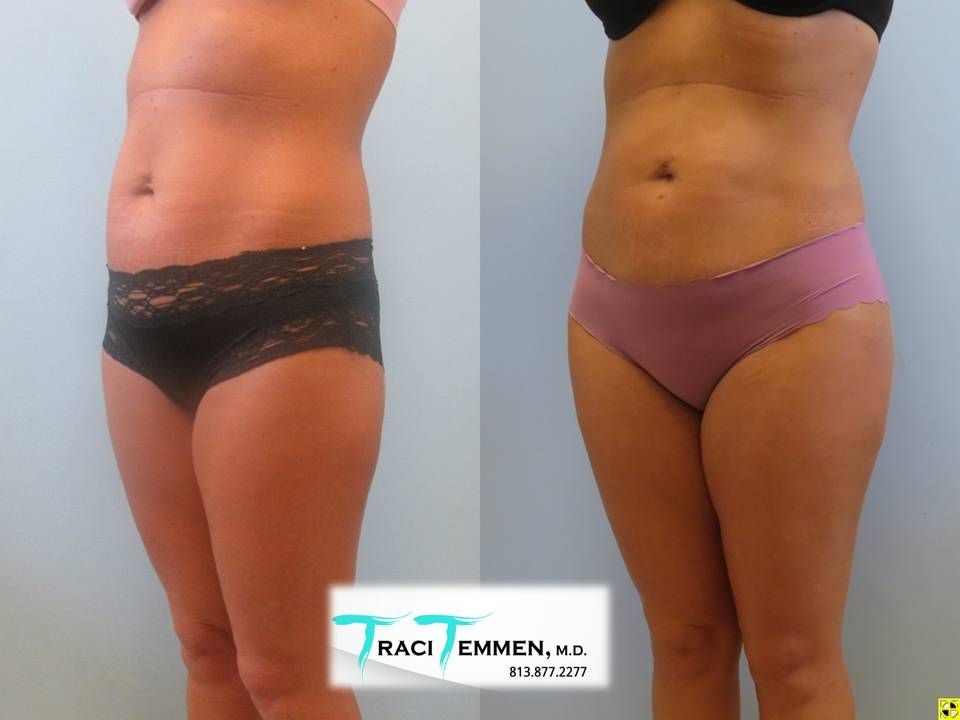 Skinny Brazilian Butt Lift Before & After