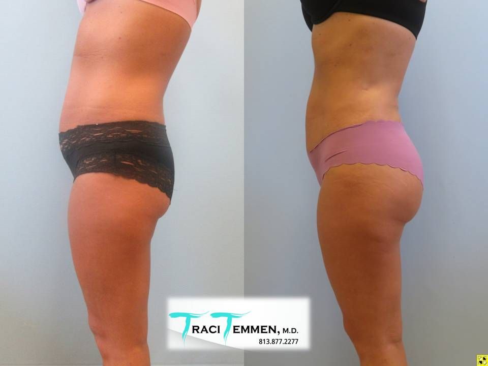 Skinny Brazilian Butt Lift Before & After