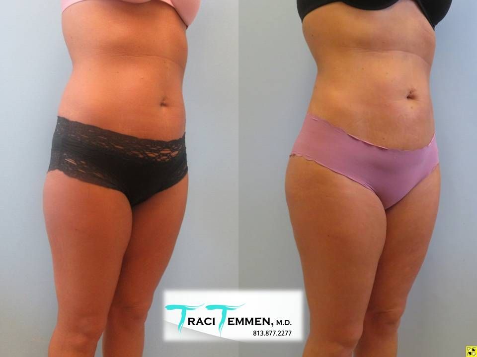 Skinny Brazilian Butt Lift Before & After