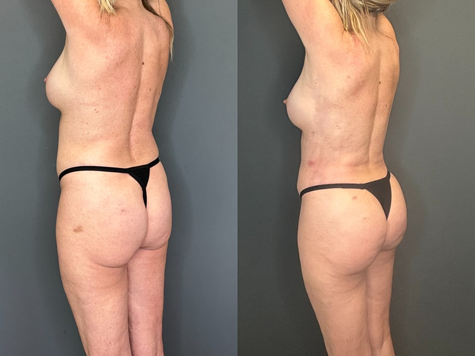 Skinny Brazilian Butt Lift Before & After