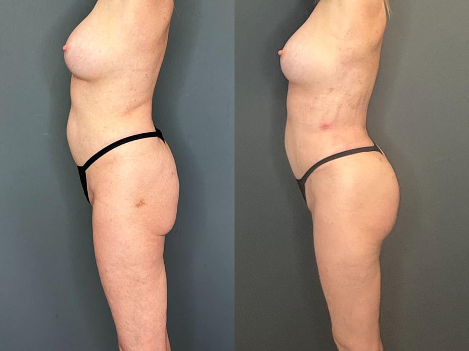 Skinny Brazilian Butt Lift Before & After