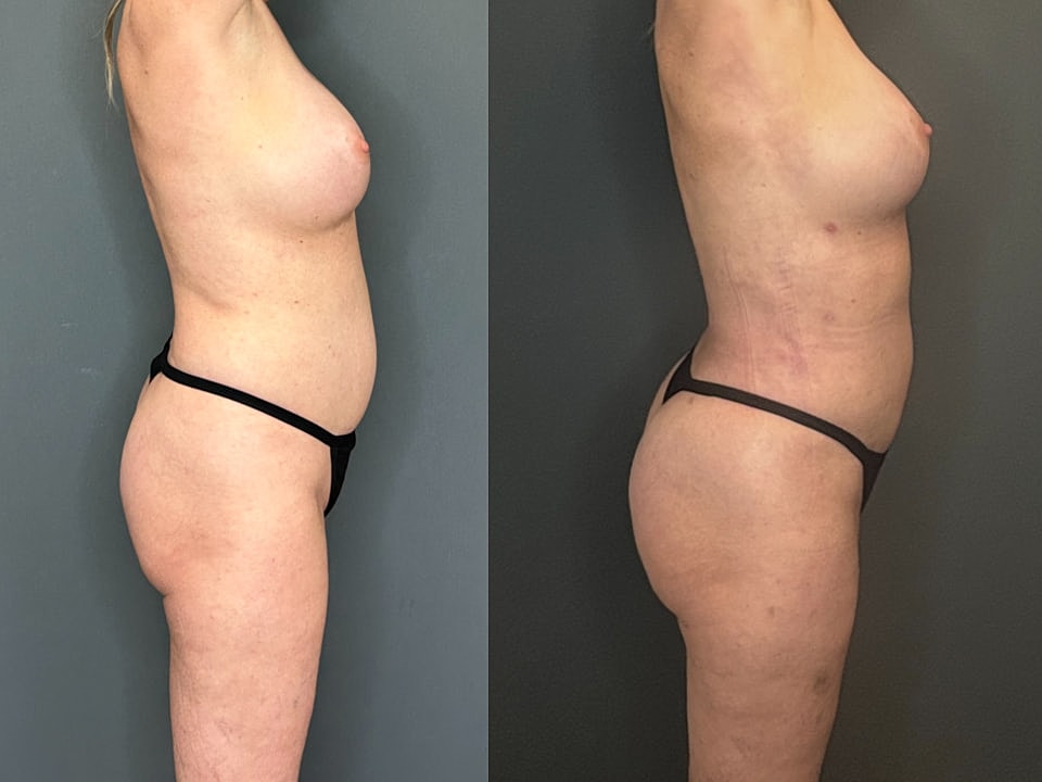 Skinny Brazilian Butt Lift Before & After