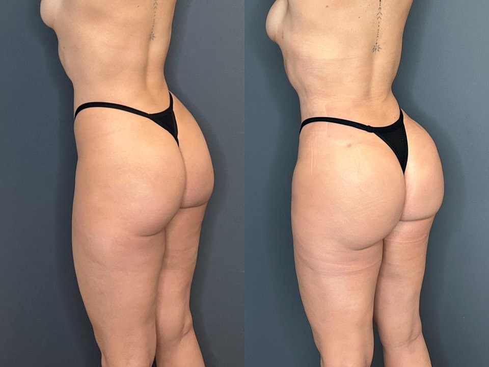 Skinny Brazilian Butt Lift Before & After