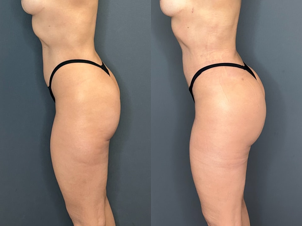 Skinny Brazilian Butt Lift Before & After