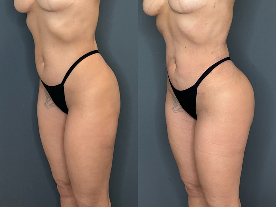 Skinny Brazilian Butt Lift Before & After