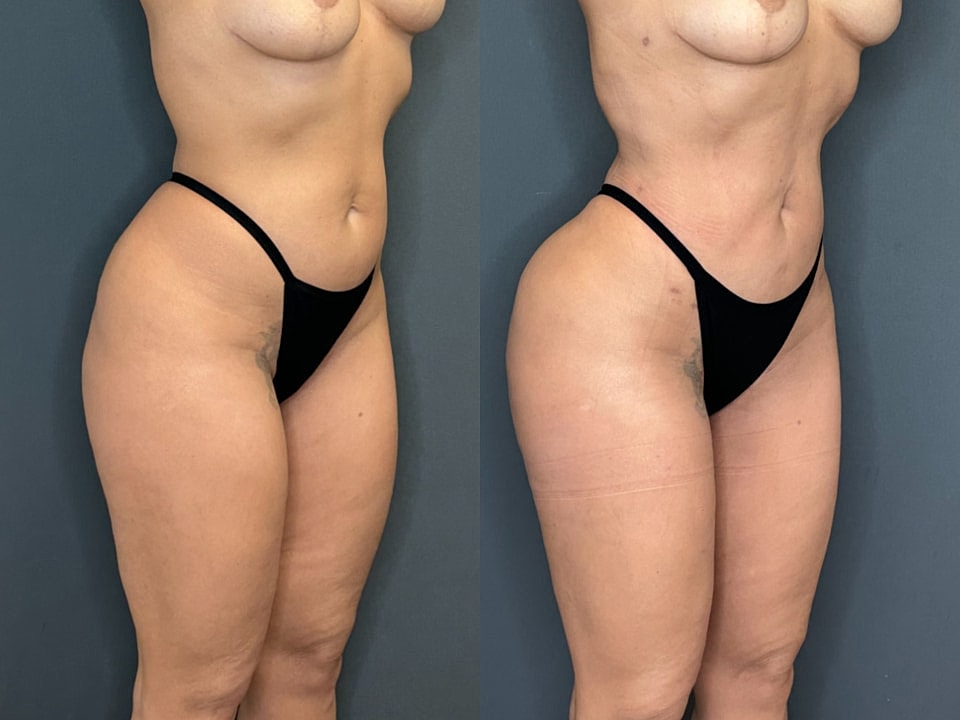 Skinny Brazilian Butt Lift Before & After