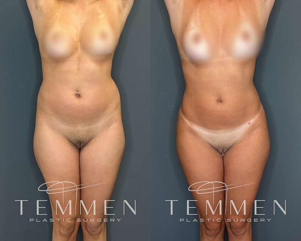 Before and after body contouring results.