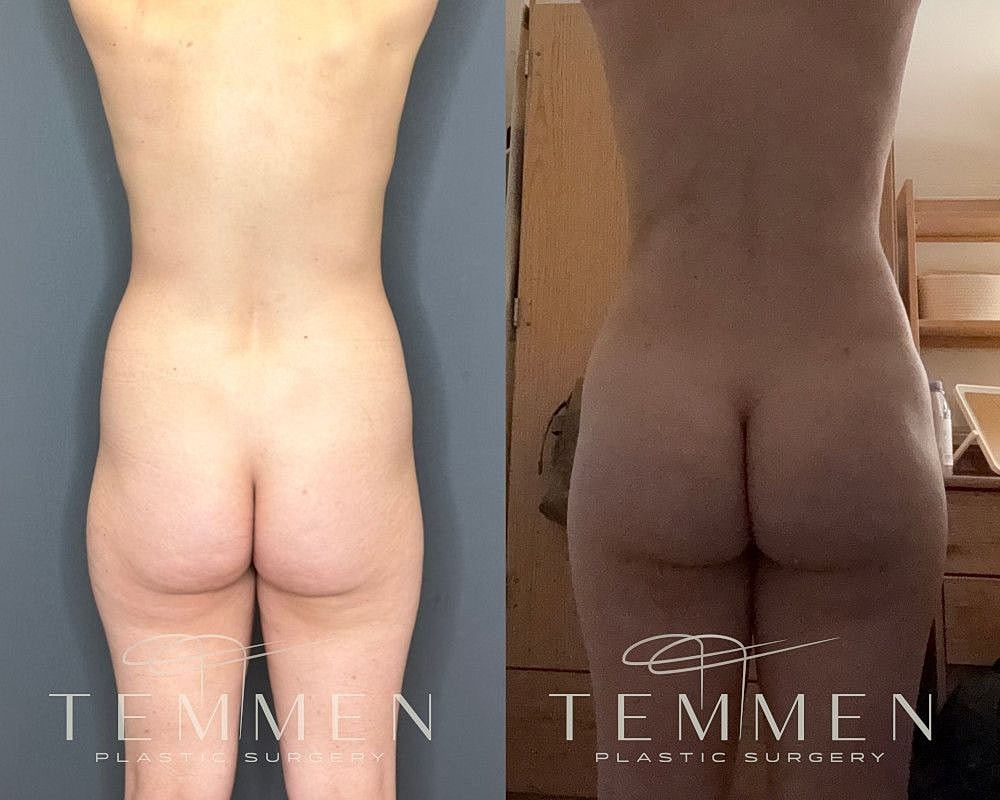 Skinny Brazilian Butt Lift Before & After