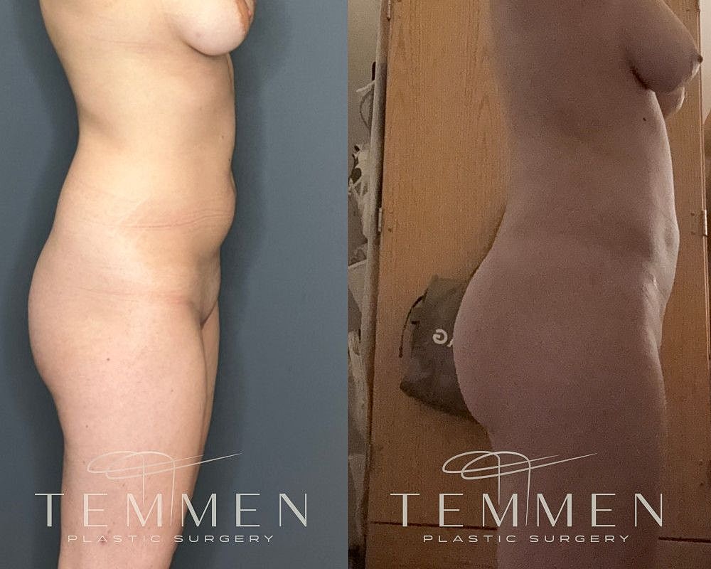 Skinny Brazilian Butt Lift Before & After