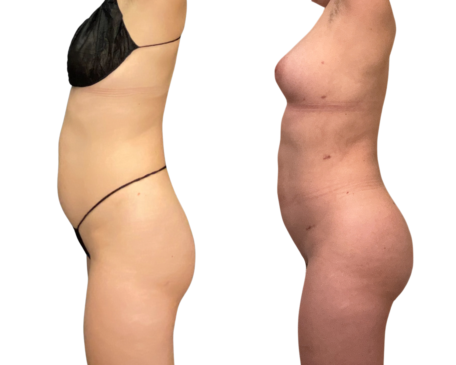 Skinny Brazilian Butt Lift Before & After