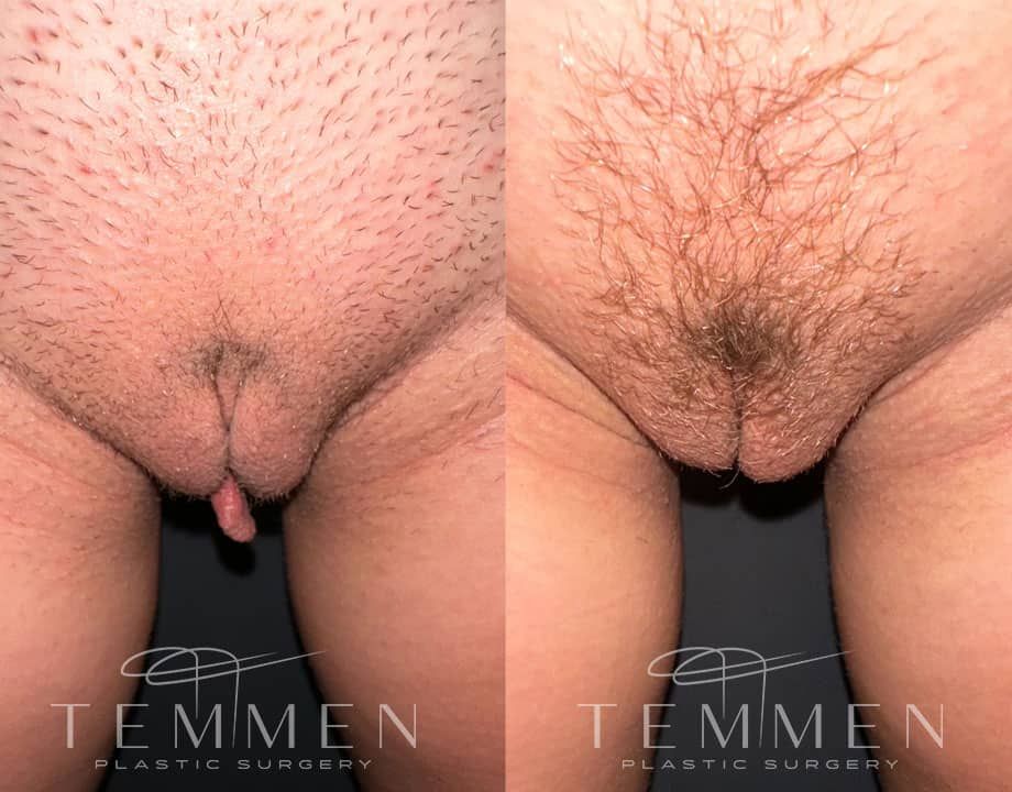 Labiaplasty Before & After