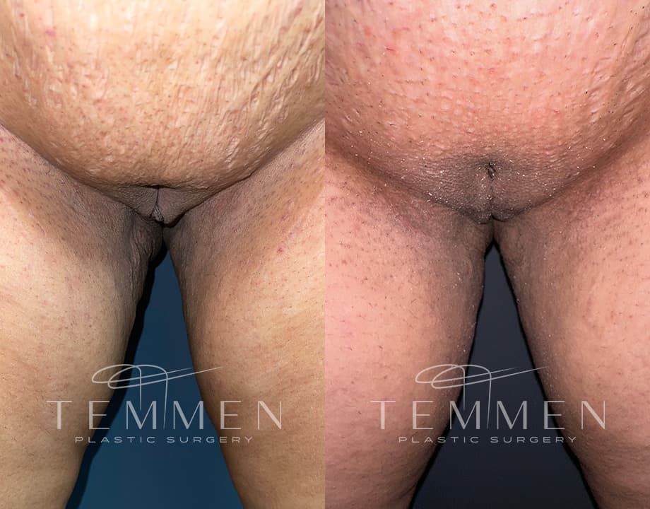 Labiaplasty Before & After