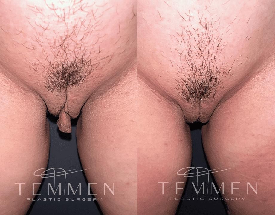 Labiaplasty Before & After