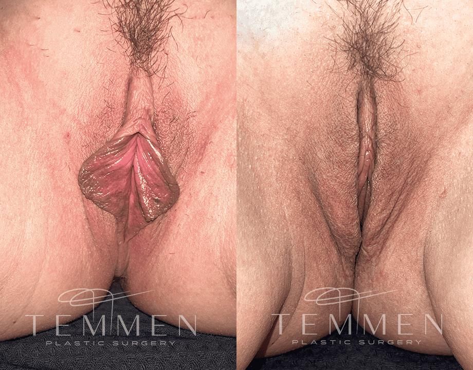 Labiaplasty Before & After