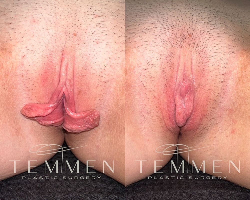 Surgical results of genital transformation procedure.