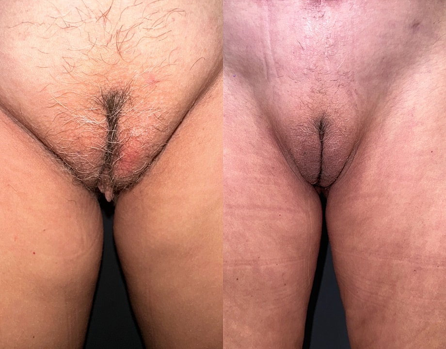 Labiaplasty Before & After
