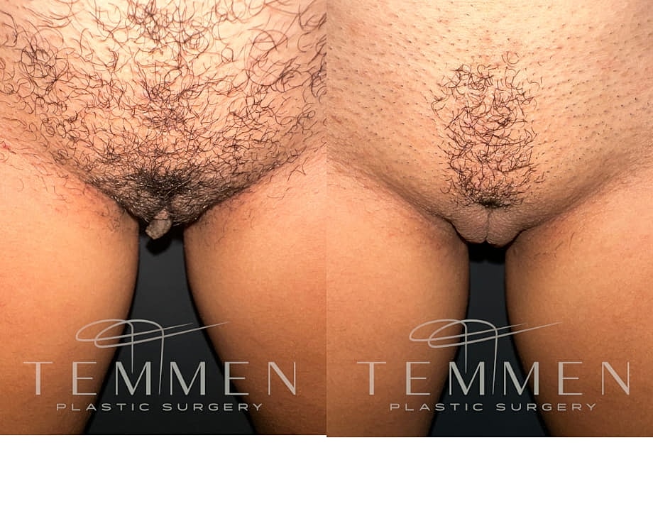 Labiaplasty Before & After