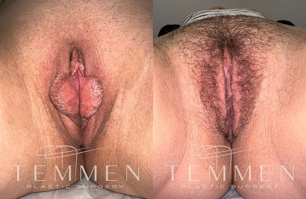 Surgical before and after images of intimate area.