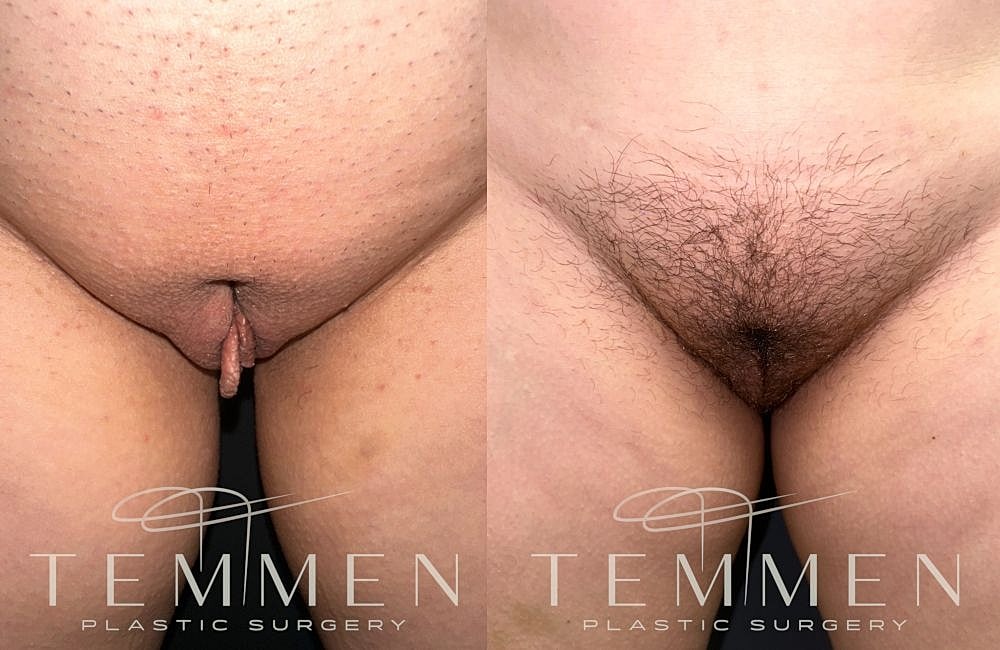 Before and after plastic surgery transformation.
