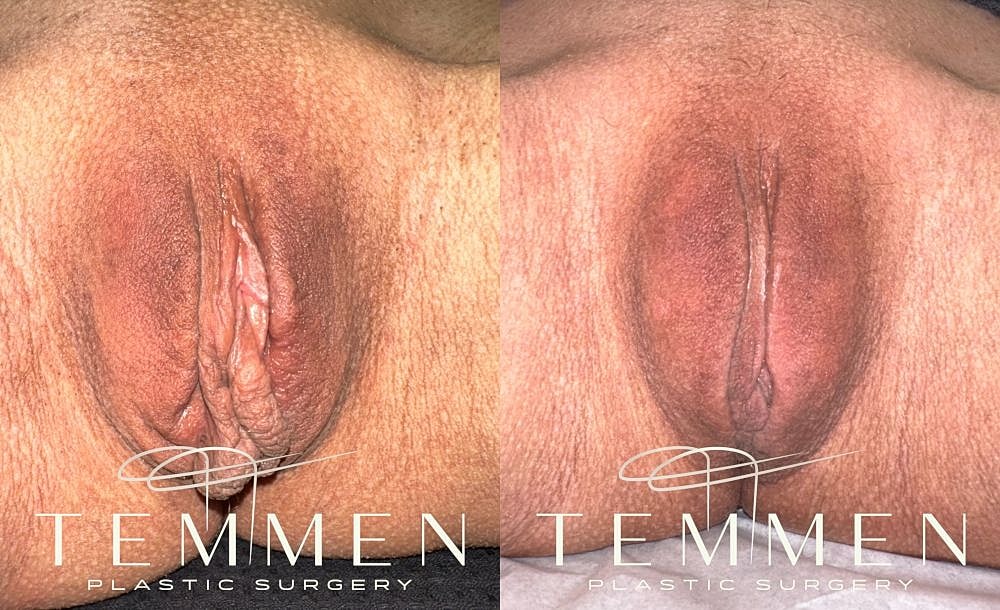 Before and after plastic surgery results comparison