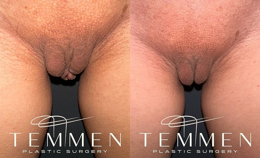 Before and after plastic surgery results.