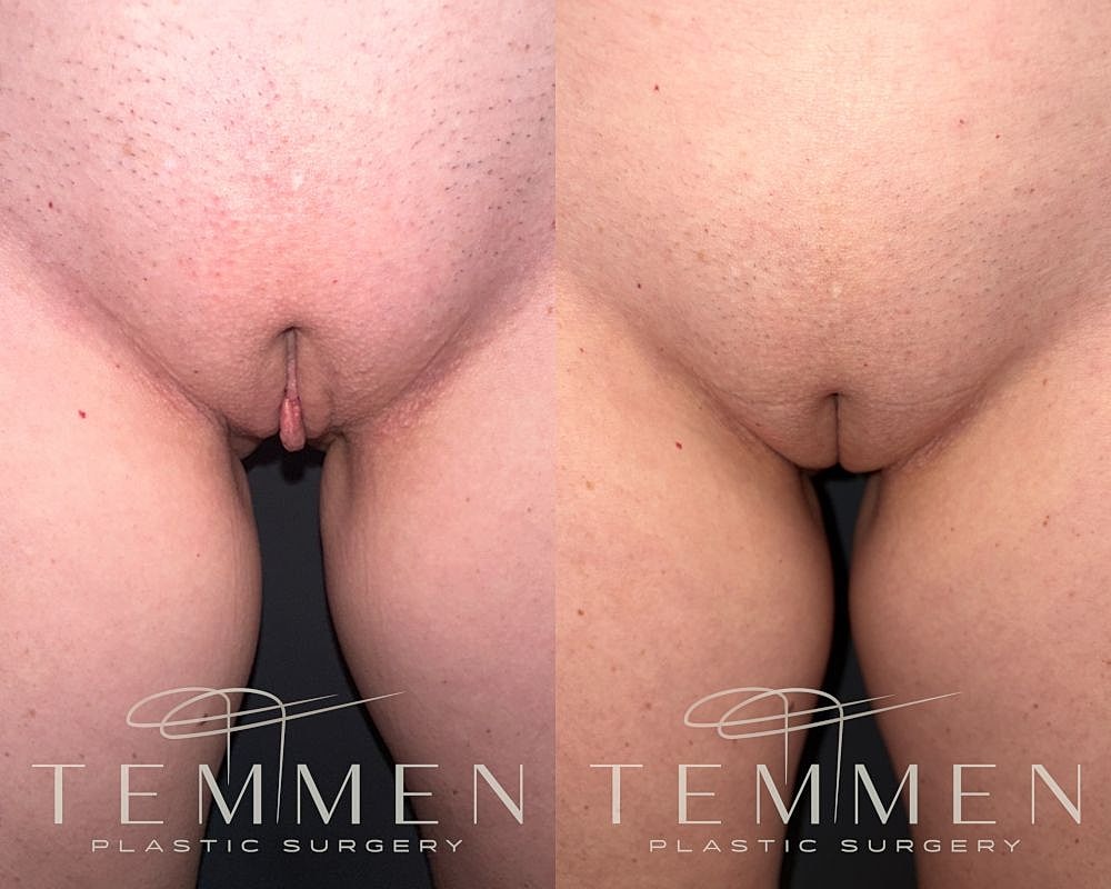 Labiaplasty Before & After